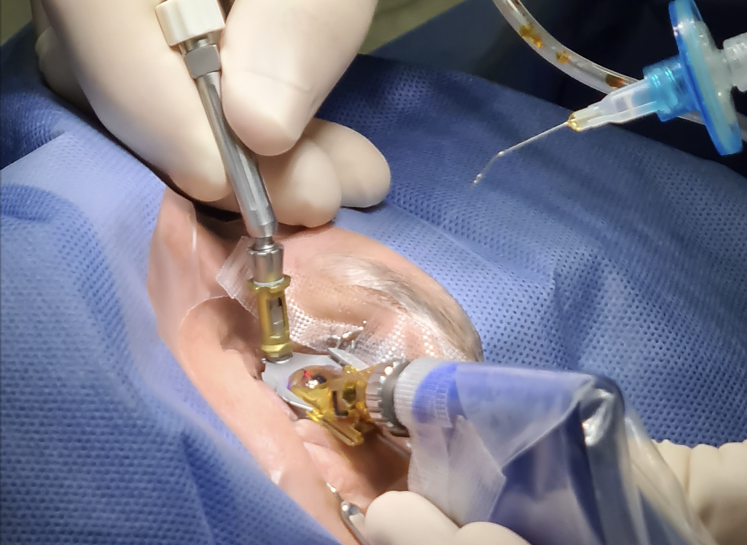 Manzatti-Informaciones-Lasik-Miopia-1