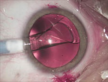 Manzitti-Prestaciones-Lentes Intraoculares de Alta Miopia-2