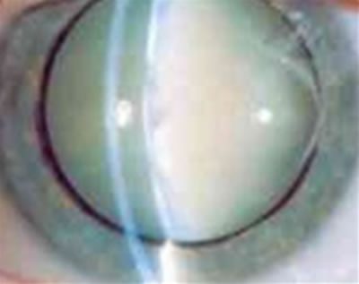 Manzatti-Informaciones-Catarata-del-Adulto-2