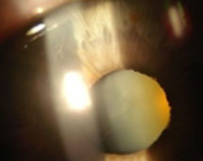 Manzatti-Informaciones-Catarata-del-Adulto-3