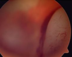 Manzatti-Informaciones-Retinoblastoma-2