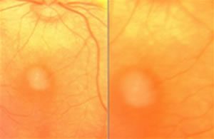 Manzitti-Informaciones-Retinoblastoma-3
